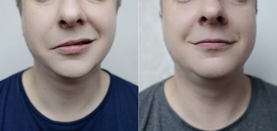 Vergleich einer männlichen Mundpartie, links schiefer Mundwinkel, rechts verbesserte Symmetrie